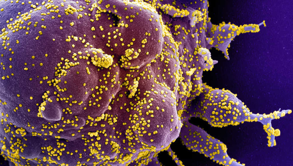 Micrografía electrónica de barrido coloreada de una célula apoptóticainfectada con partículas del virus SARS-COV-2
