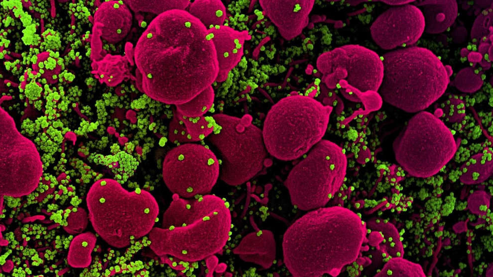Micrografía electrónica de barrido coloreada de una célula apoptótica (rosa) muy infectada con partículas del virus SARS-COV-2 (verde), aislada de una muestra de un paciente.